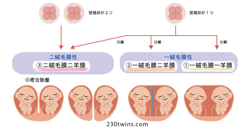 体外受精は双子が多い 産婦人科じょいの本音
