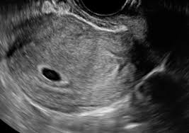 胎嚢っていつ見えるの 産婦人科じょいの本音